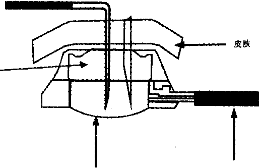 图1 静脉输液港假性梗阻示意图