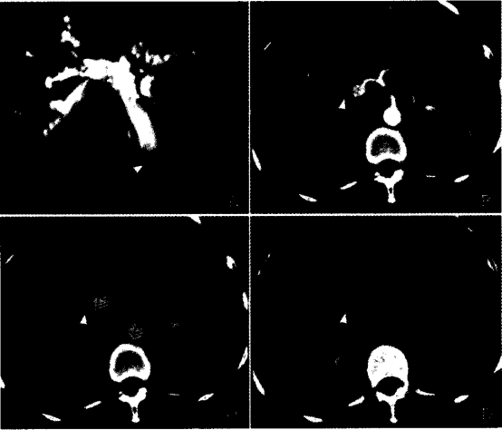 图1 恶性胆道狭窄的DCE-CT、MRCP影像图