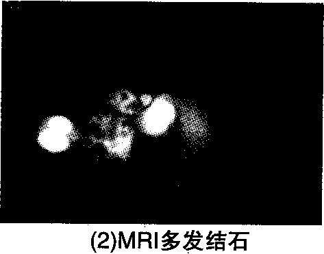 图2 胆总管结石MSCT未确诊而MRI确诊影像图